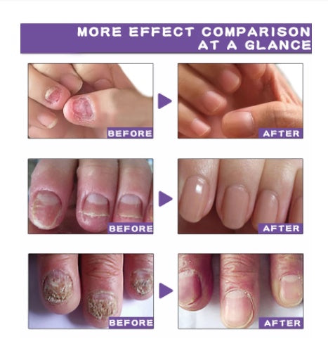 Nail Fungus Treatment Serum Fast Nail Repair