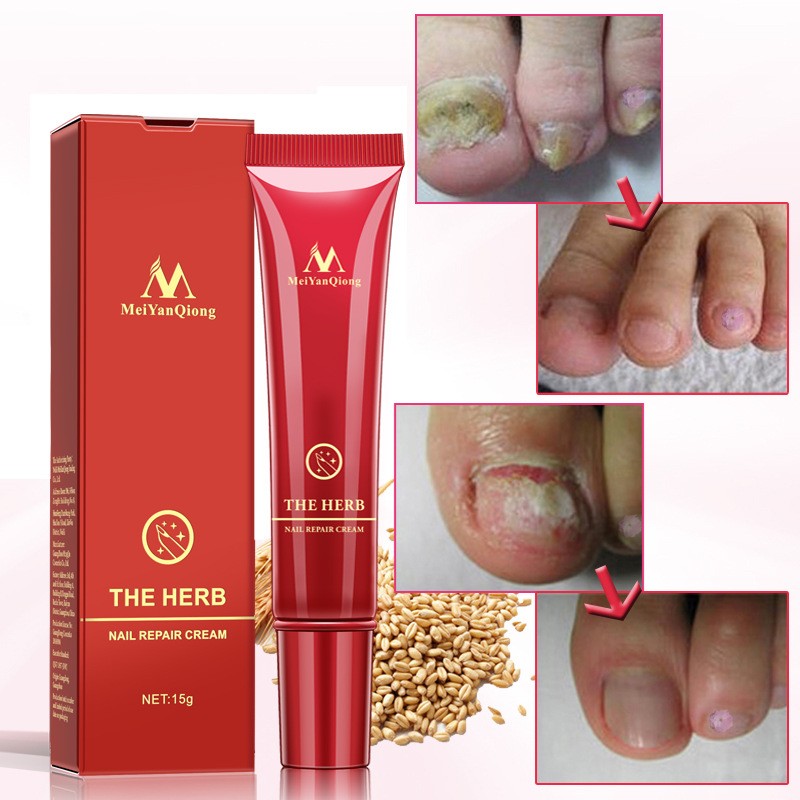 Toenail Fungus Treatment Cream Fast Nail Repair