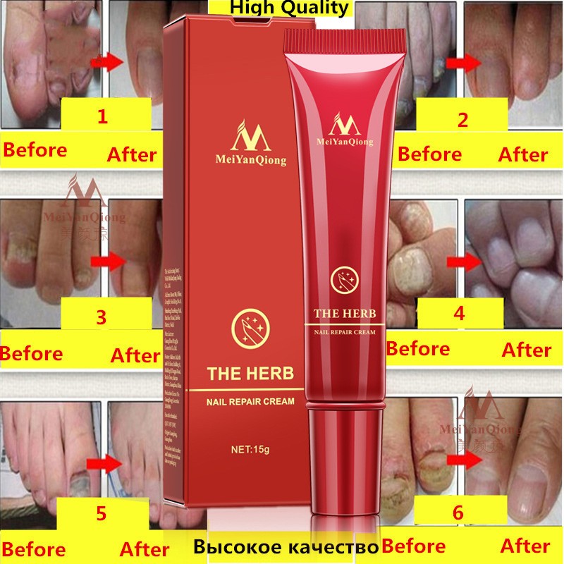 Toenail Fungus Treatment Cream Fast Nail Repair